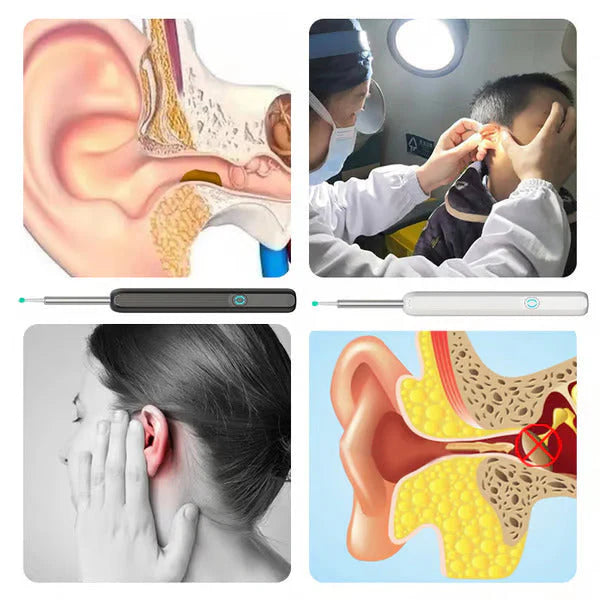 Smart Visual Otoscope Ear Wax Removal Tool, Ear Wax Removal Tool, Mini Camera for Ear Health Care